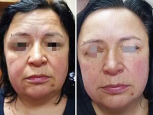 Міофасціальний масаж обличчя