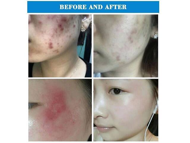 Портативный аппарат дарсонвализации Acne Meter WD-354 - Фото 6