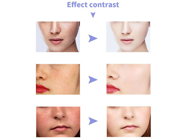 Портативный плазменный коагулятор Beauco WD-0232 (3 насадки) - Фото 9