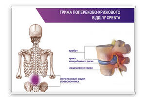 Плакат Vivay Грижа попереково-крижового відділу хребета А1 (8912)