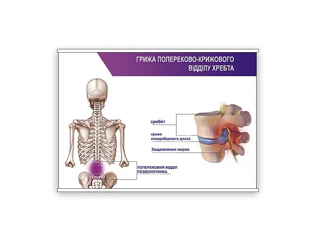 Плакат Vivay Грижа попереково-крижового відділу хребета А0 (8911)