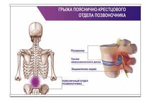 Плакат Vivay Грыжа пояснично-крестцового отдела позвоночника А0 (8863)