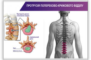 Плакат Vivay Протрузія попереково-крижового відділу А0 (8935)