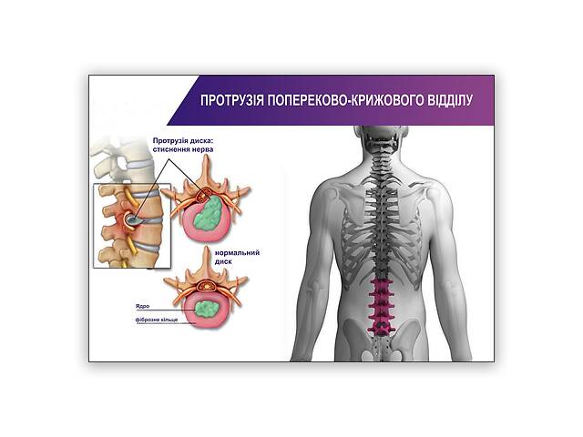 Плакат Vivay Протрузія попереково-крижового відділу А1