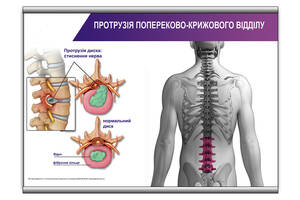 Плакат Vivay Протрузія попереково-крижового відділу с планкой А1 (9040)