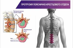 Плакат Vivay Протрузия пояснично-крестцового отдела А1