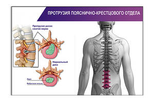 Плакат Vivay Протрузия пояснично-крестцового отдела А0 (4684)